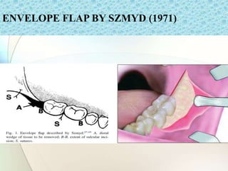 ENVELOPE FLAP BY SZMYD (1971)
 