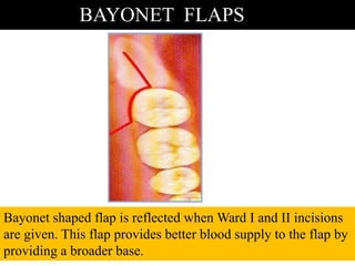 BAYONET FLAPS
Bayonet shaped flap is reflected when Ward I and II incisions
are given. This flap provides better blood supply to the flap by
providing a broader base.
 