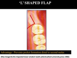 ‘L’ SHAPED FLAP
Advantage : Prevents pocket formation distal to second molar.
(Mac GregorAJ.the impacted lower wisdom tooth.oxford:oxford university press 1985)
 