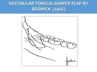 VESTIBULAR TONGUE-SHAPED FLAP BY
BERWICK (1966)
 