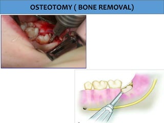OSTEOTOMY ( BONE REMOVAL)
 