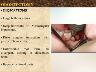 ODONTECTOMY
• INDICATIONS :
• Large bulbous crown.
• Deep horizontal or Mesioangular
impactions.
• Disto angular impactions with
plenty of bone cover.
• Unfavorable root form like
divergent, locking or dilacerated
roots.
• Hypercementosed roots.
 