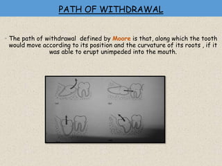 PATH OF WITHDRAWAL
• The path of withdrawal defined by Moore is that, along which the tooth
would move according to its position and the curvature of its roots , if it
was able to erupt unimpeded into the mouth.
 
