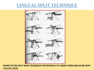 LINGUAL SPLIT TECHNIQUE
(WARD TG:THE SPLIT BONE TECHNIQUE FOR REMOVAL OF LOWER THIRD MOLAR.BR DENT
J 101:297,1956)
 