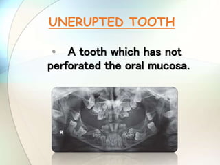 • A tooth which has not
perforated the oral mucosa.
UNERUPTED TOOTH
 