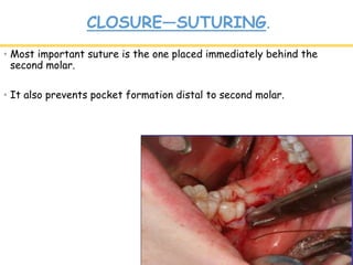 CLOSURE—SUTURING.
• Most important suture is the one placed immediately behind the
second molar.
• It also prevents pocket formation distal to second molar.
 