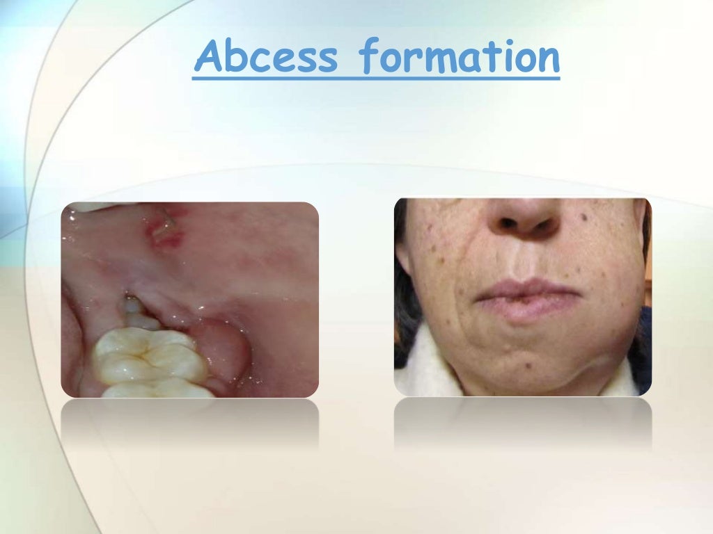 IMPACTION IN ORAL SURGERY