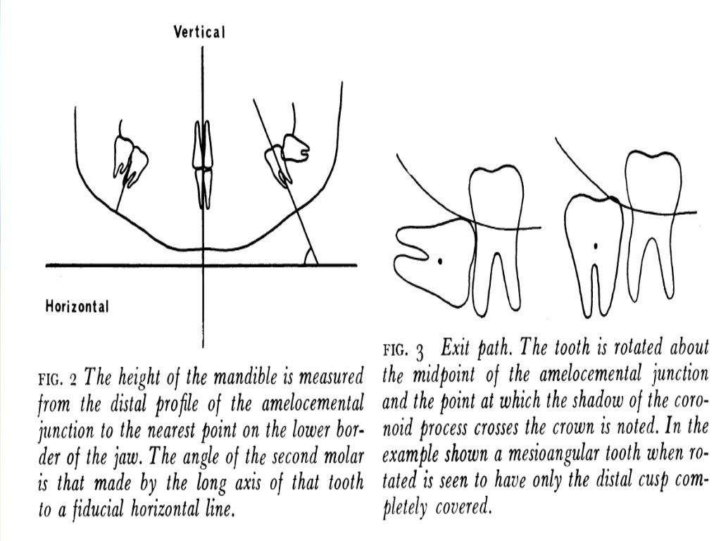 IMPACTION IN ORAL SURGERY