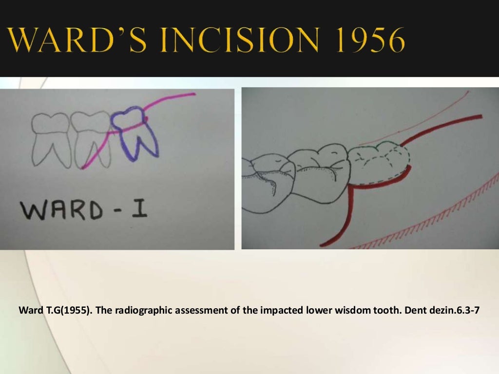 IMPACTION IN ORAL SURGERY
