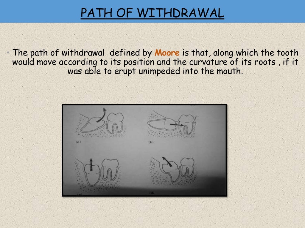 IMPACTION IN ORAL SURGERY