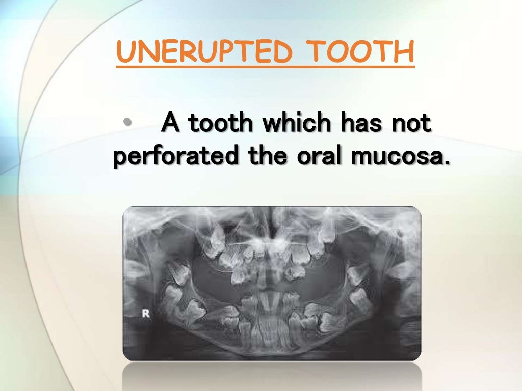 IMPACTION IN ORAL SURGERY
