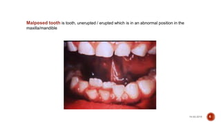 impaction-180414170525.pptx