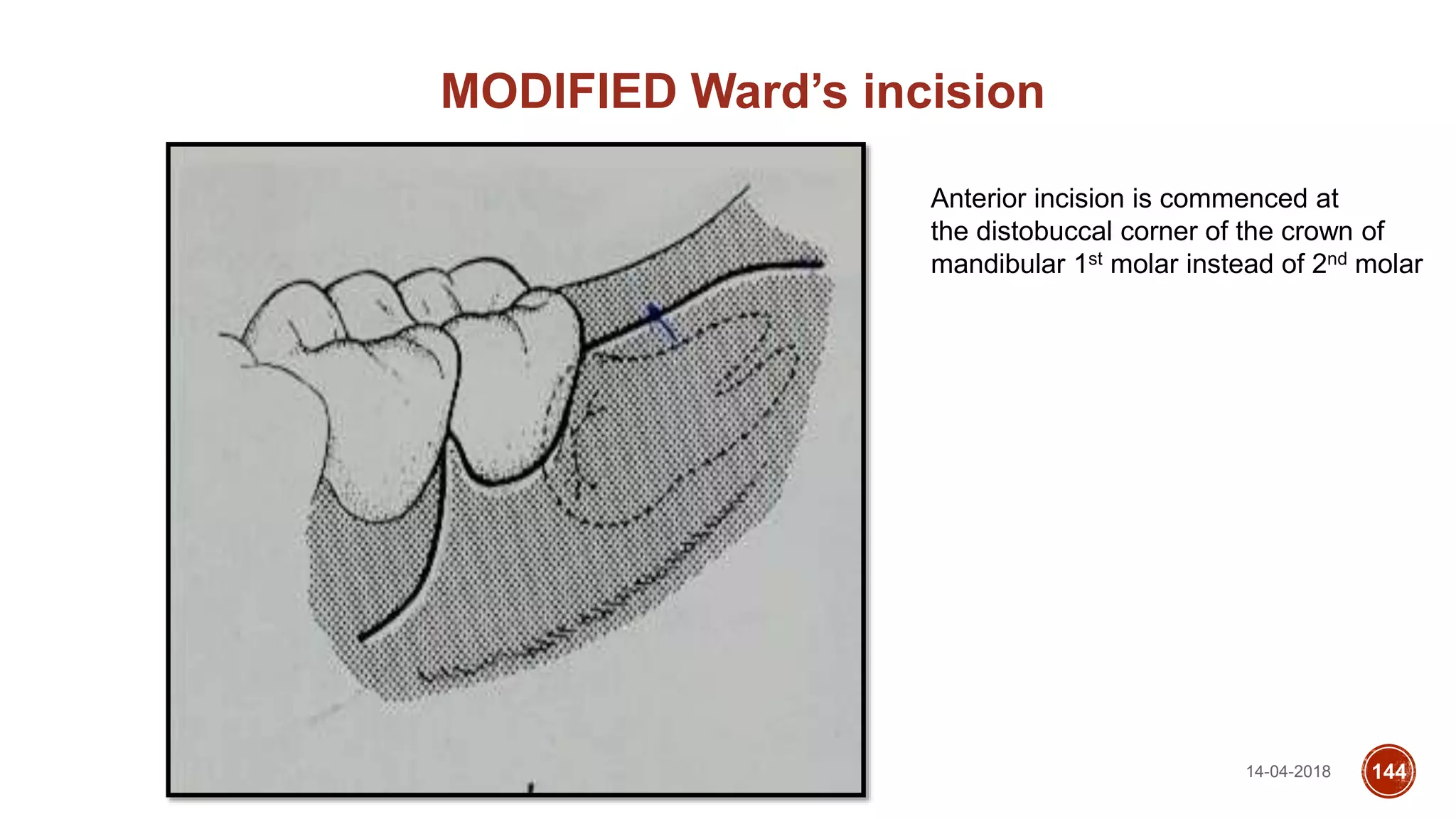 14-04-2018 144
MODIFIED Ward’s incision
Anterior incision is commenced at
the distobuccal corner of the crown of
mandibular 1st molar instead of 2nd molar
 