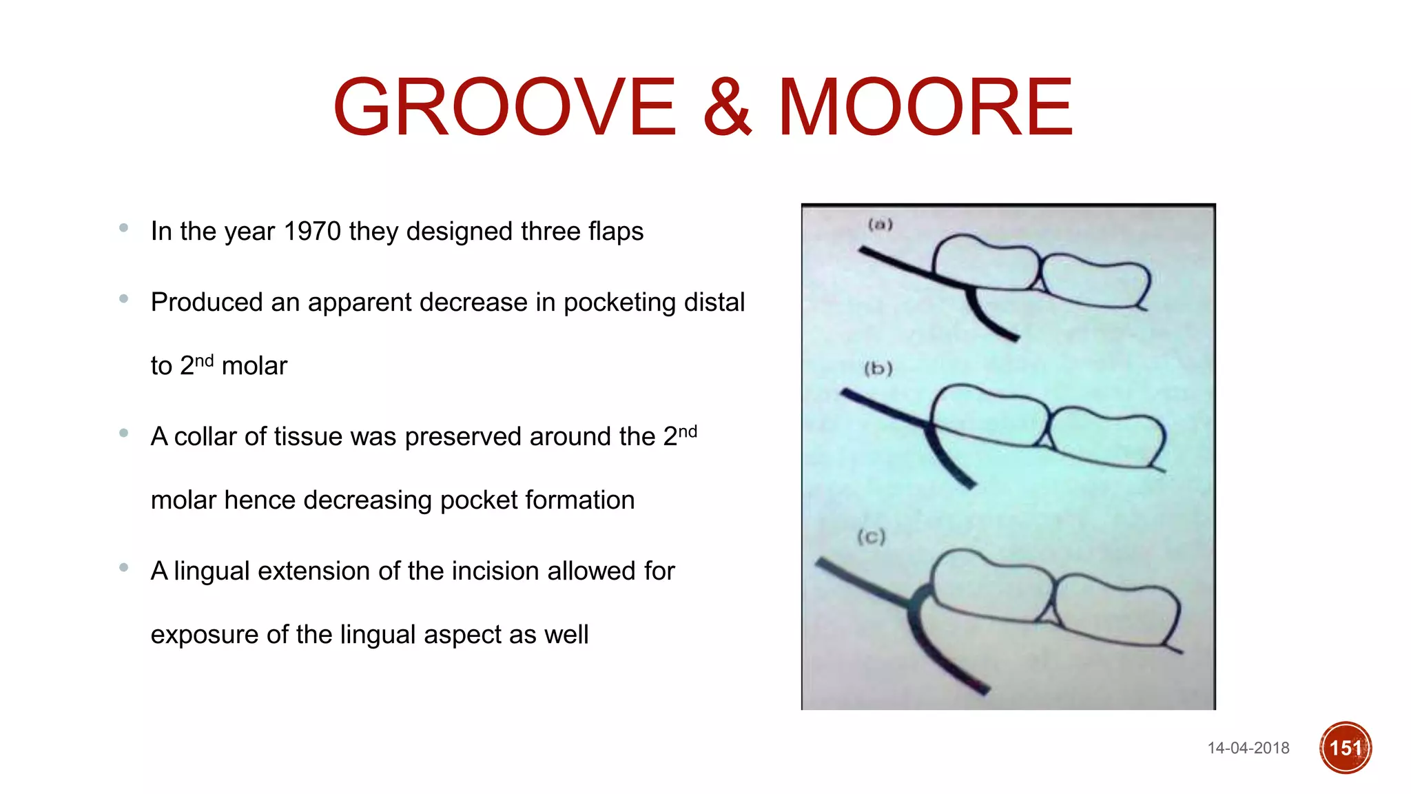 14-04-2018 151
GROOVE & MOORE
• In the year 1970 they designed three flaps
• Produced an apparent decrease in pocketing distal
to 2nd molar
• A collar of tissue was preserved around the 2nd
molar hence decreasing pocket formation
• A lingual extension of the incision allowed for
exposure of the lingual aspect as well
 