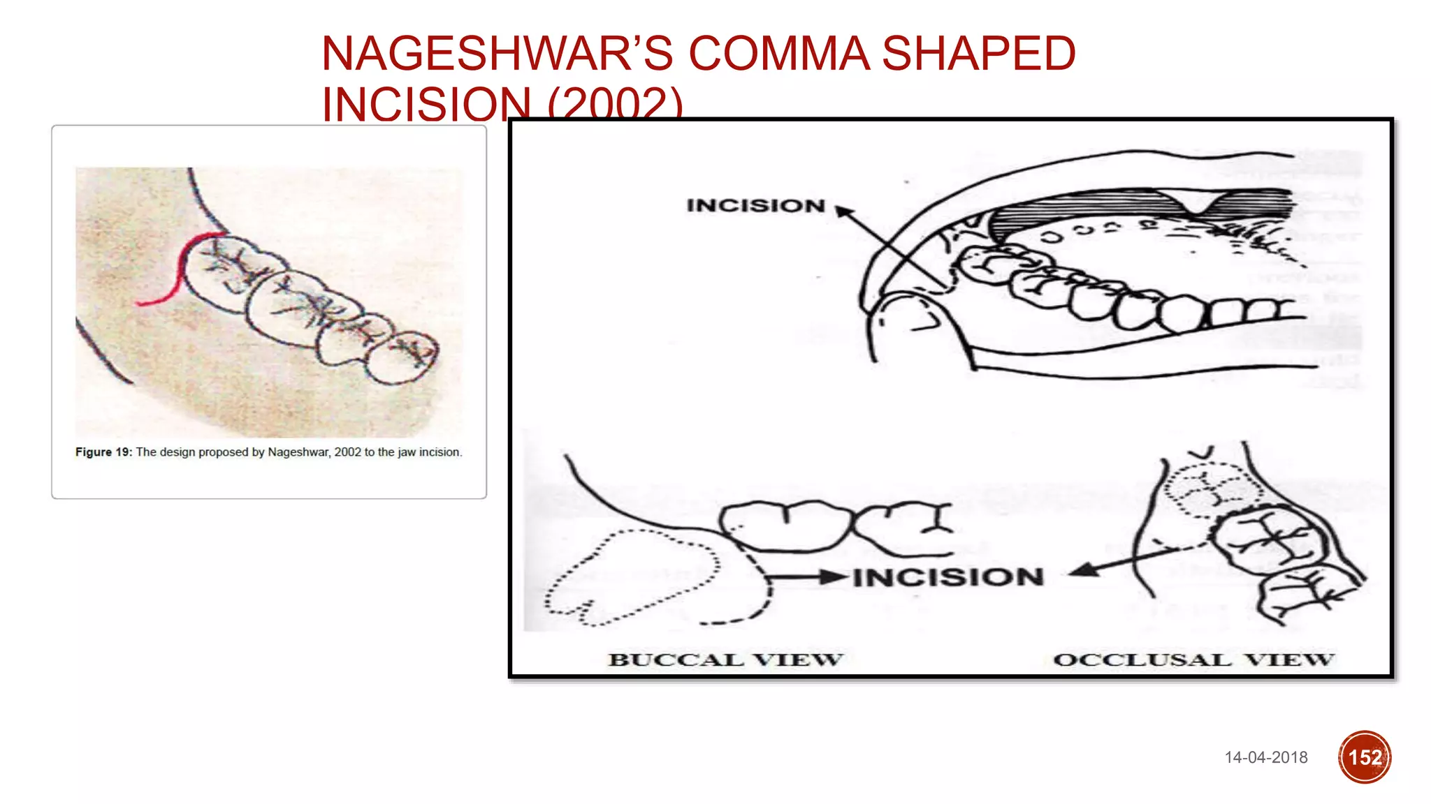 14-04-2018 152
NAGESHWAR’S COMMA SHAPED
INCISION (2002)
 
