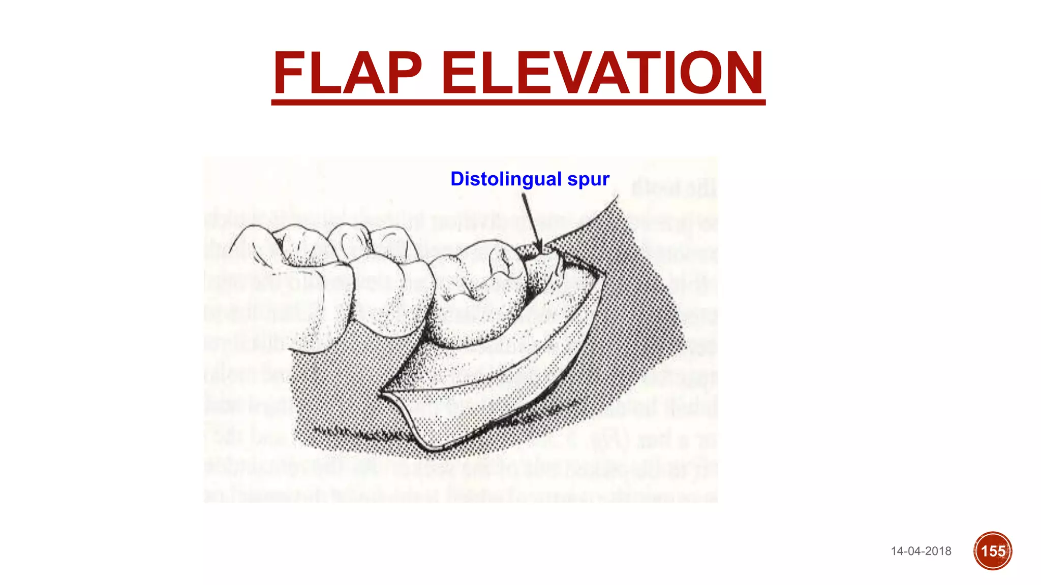 FLAP ELEVATION
Distolingual spur
14-04-2018 155
 