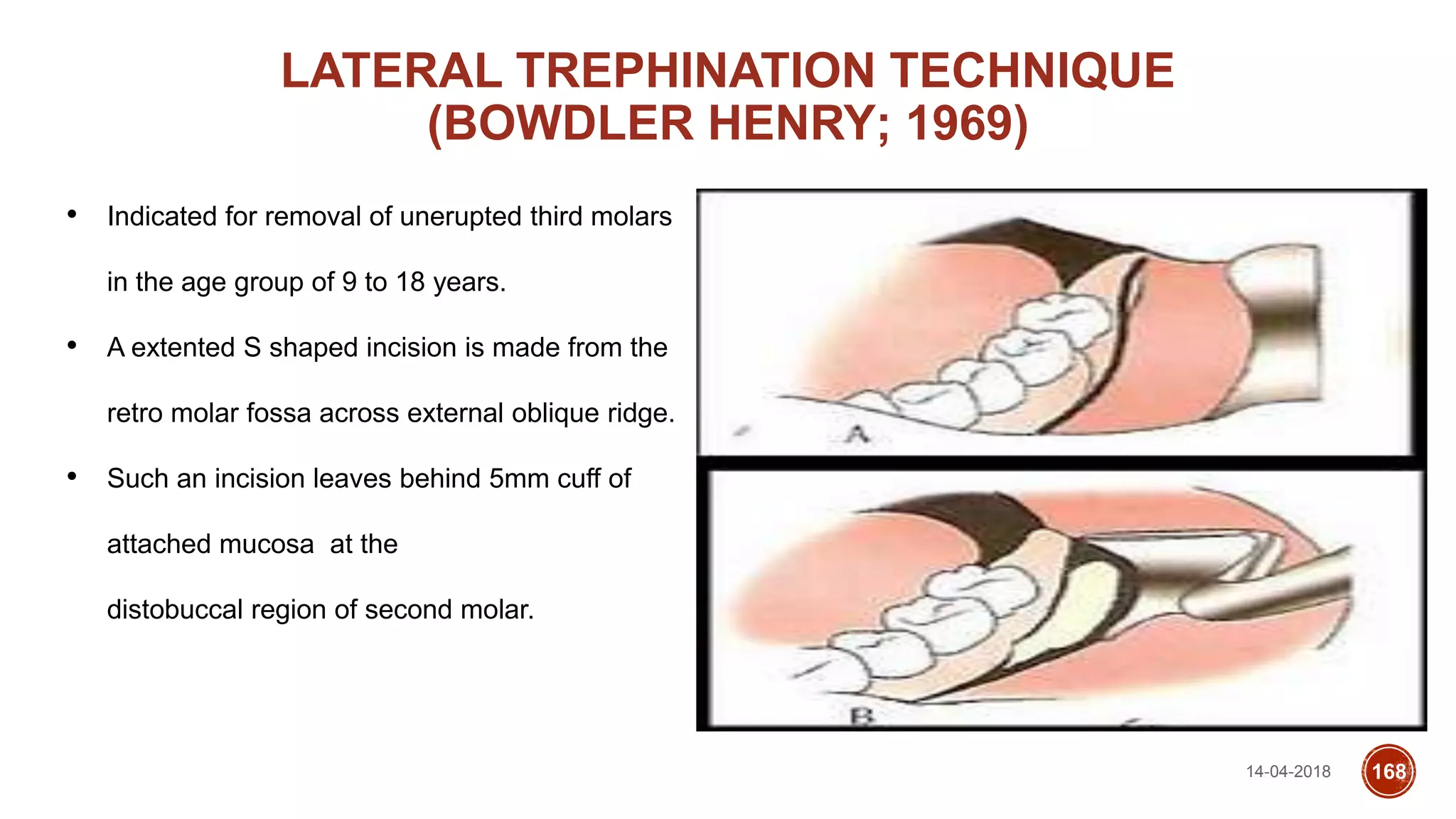14-04-2018 168
LATERAL TREPHINATION TECHNIQUE
(BOWDLER HENRY; 1969)
• Indicated for removal of unerupted third molars
in the age group of 9 to 18 years.
• A extented S shaped incision is made from the
retro molar fossa across external oblique ridge.
• Such an incision leaves behind 5mm cuff of
attached mucosa at the
distobuccal region of second molar.
 