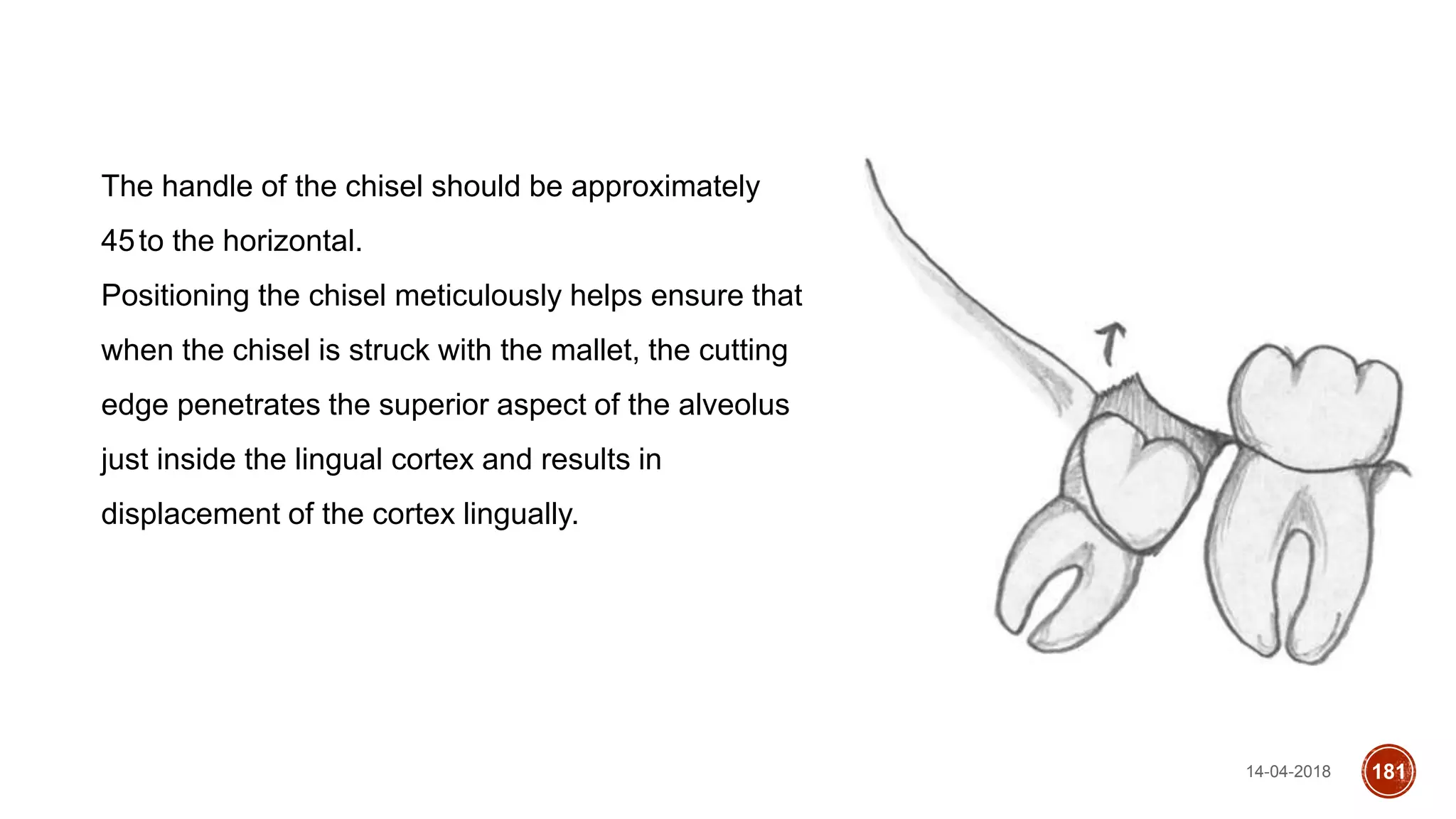 14-04-2018 181
The handle of the chisel should be approximately
45to the horizontal.
Positioning the chisel meticulously helps ensure that
when the chisel is struck with the mallet, the cutting
edge penetrates the superior aspect of the alveolus
just inside the lingual cortex and results in
displacement of the cortex lingually.
 