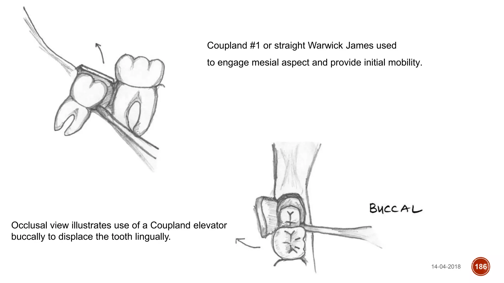 14-04-2018 186
Coupland #1 or straight Warwick James used
to engage mesial aspect and provide initial mobility.
Occlusal view illustrates use of a Coupland elevator
buccally to displace the tooth lingually.
 
