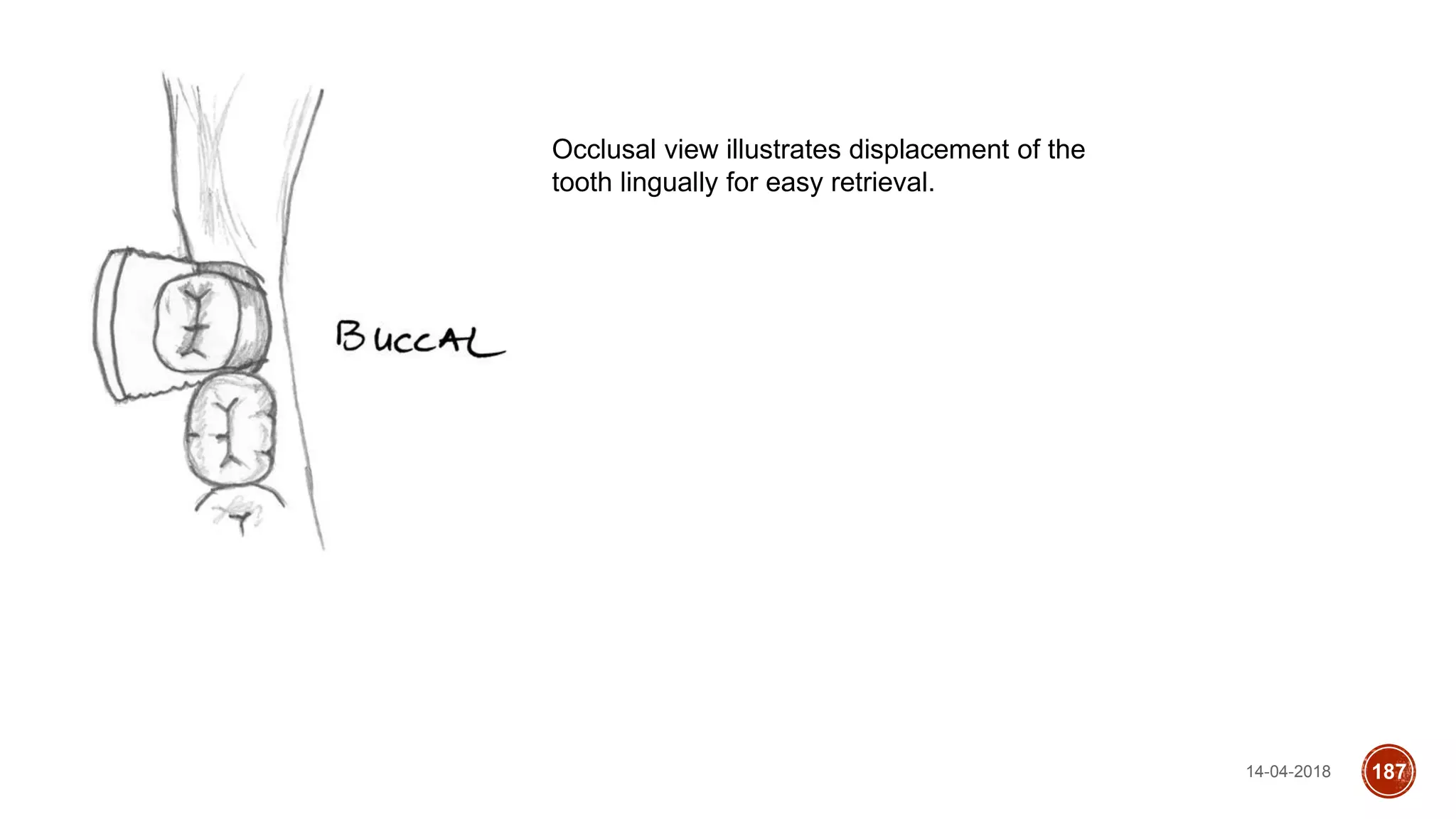 14-04-2018 187
Occlusal view illustrates displacement of the
tooth lingually for easy retrieval.
 