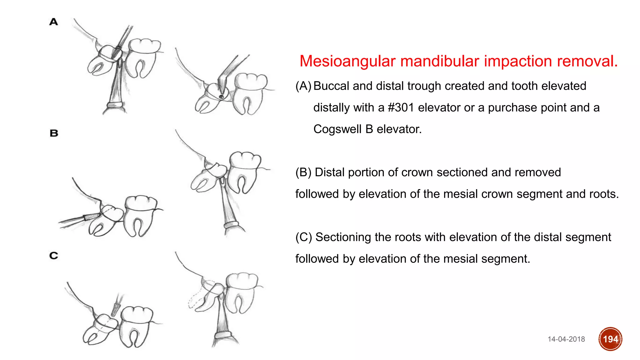 14-04-2018 194
Mesioangular mandibular impaction removal.
(A) Buccal and distal trough created and tooth elevated
distally with a #301 elevator or a purchase point and a
Cogswell B elevator.
(B) Distal portion of crown sectioned and removed
followed by elevation of the mesial crown segment and roots.
(C) Sectioning the roots with elevation of the distal segment
followed by elevation of the mesial segment.
 