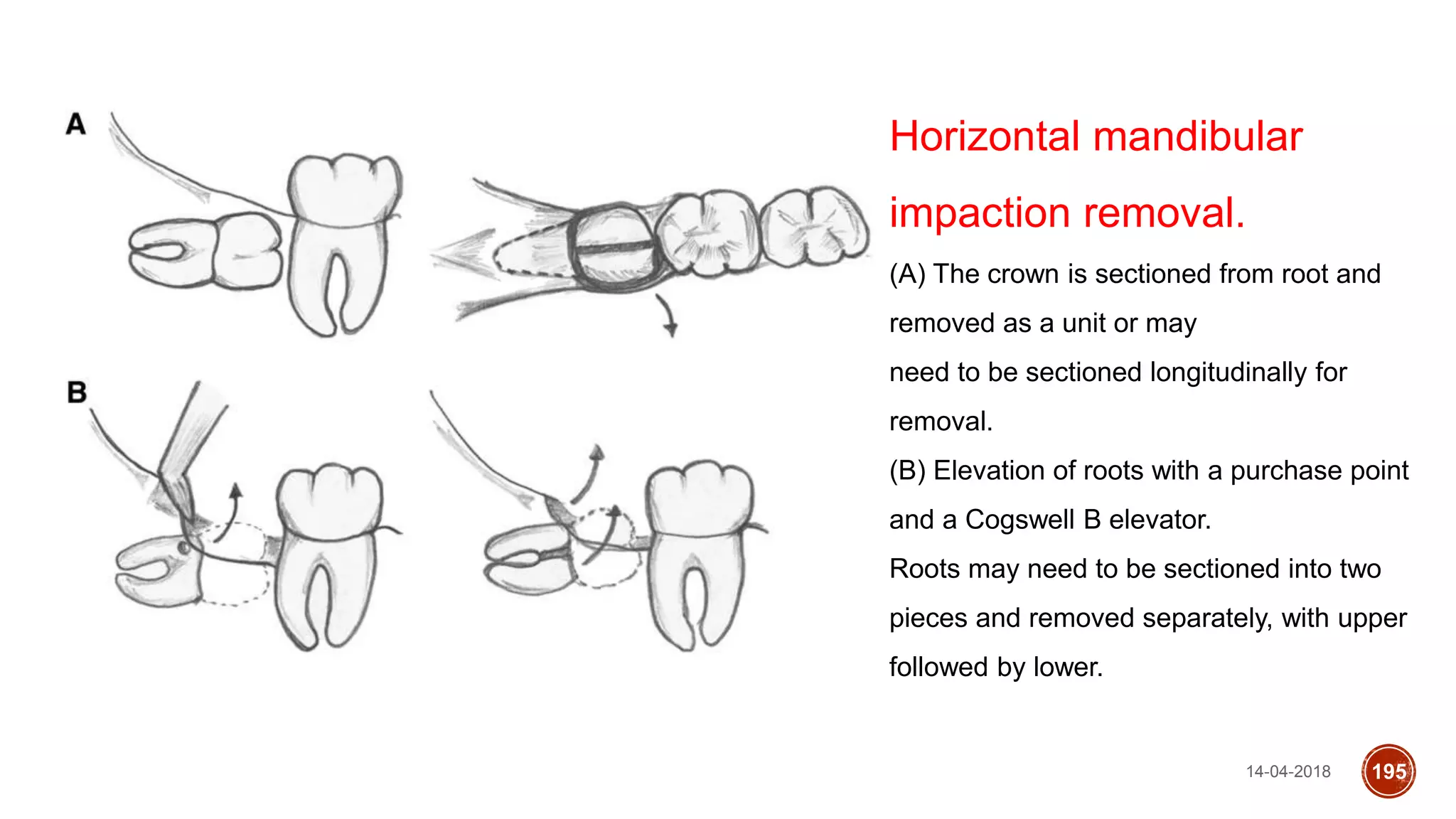 14-04-2018 195
Horizontal mandibular
impaction removal.
(A) The crown is sectioned from root and
removed as a unit or may
need to be sectioned longitudinally for
removal.
(B) Elevation of roots with a purchase point
and a Cogswell B elevator.
Roots may need to be sectioned into two
pieces and removed separately, with upper
followed by lower.
 