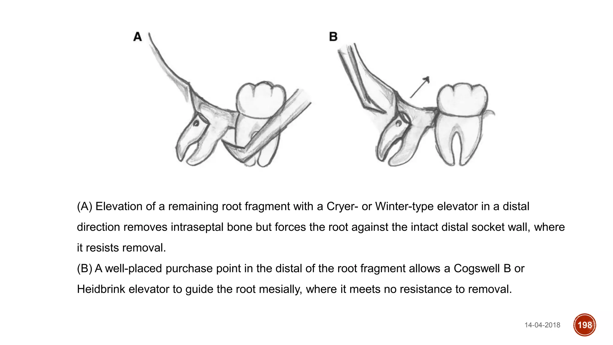 14-04-2018 198
(A) Elevation of a remaining root fragment with a Cryer- or Winter-type elevator in a distal
direction removes intraseptal bone but forces the root against the intact distal socket wall, where
it resists removal.
(B) A well-placed purchase point in the distal of the root fragment allows a Cogswell B or
Heidbrink elevator to guide the root mesially, where it meets no resistance to removal.
 