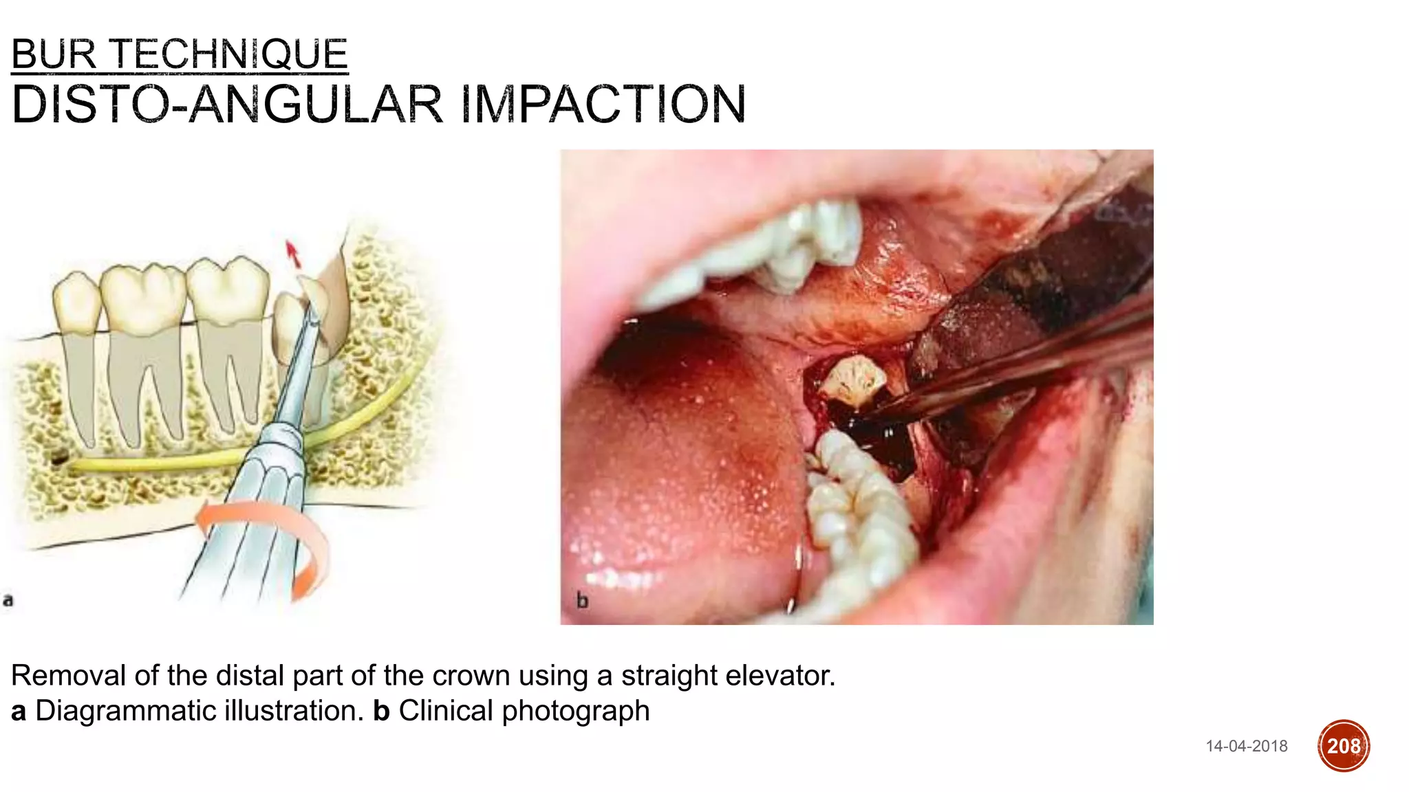 Removal of the distal part of the crown using a straight elevator.
a Diagrammatic illustration. b Clinical photograph
14-04-2018 208
 