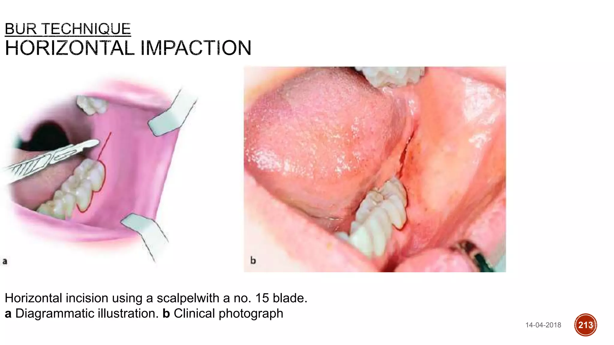 Horizontal incision using a scalpelwith a no. 15 blade.
a Diagrammatic illustration. b Clinical photograph
14-04-2018 213
 