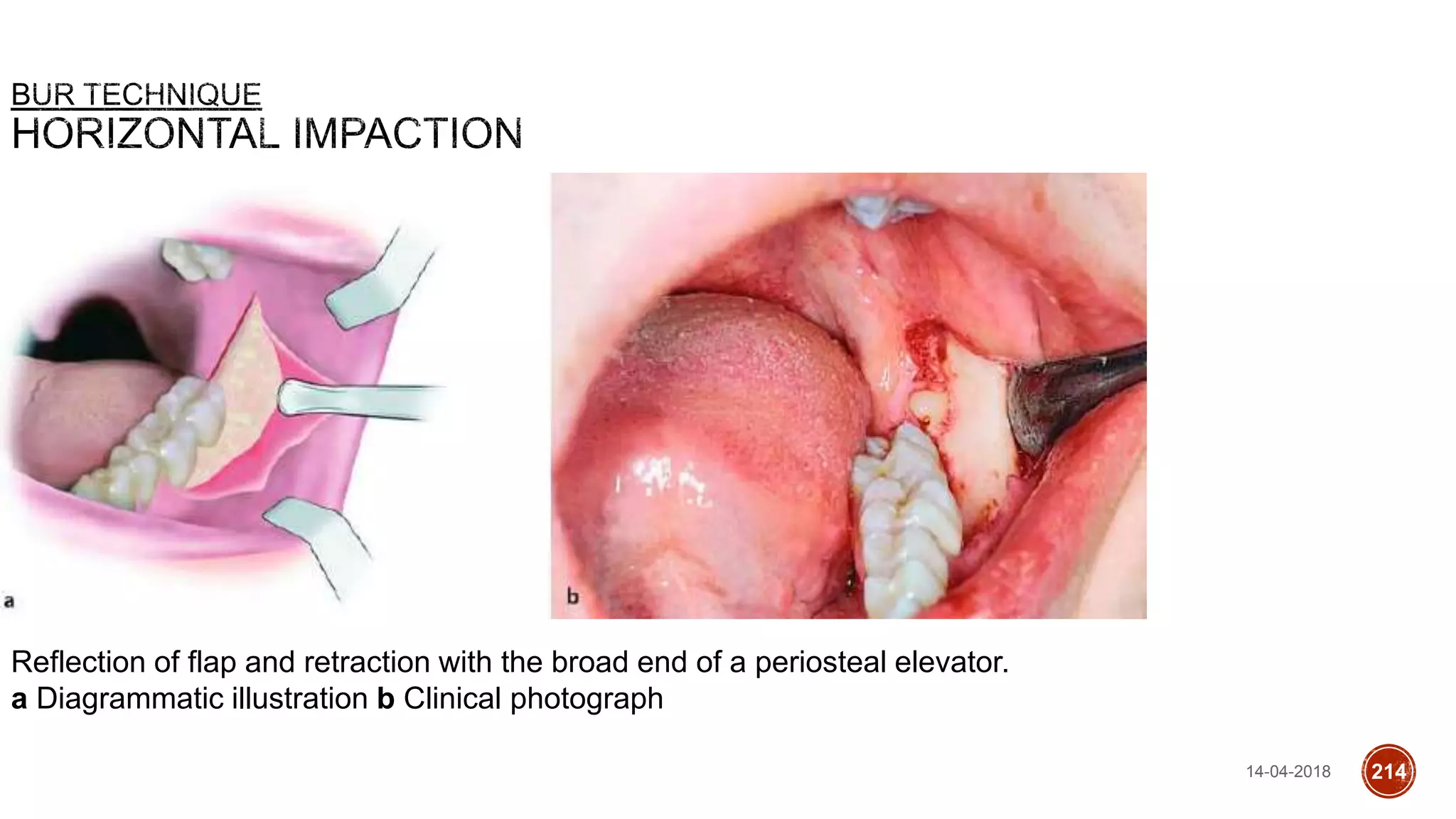 Reflection of flap and retraction with the broad end of a periosteal elevator.
a Diagrammatic illustration b Clinical photograph
14-04-2018 214
 
