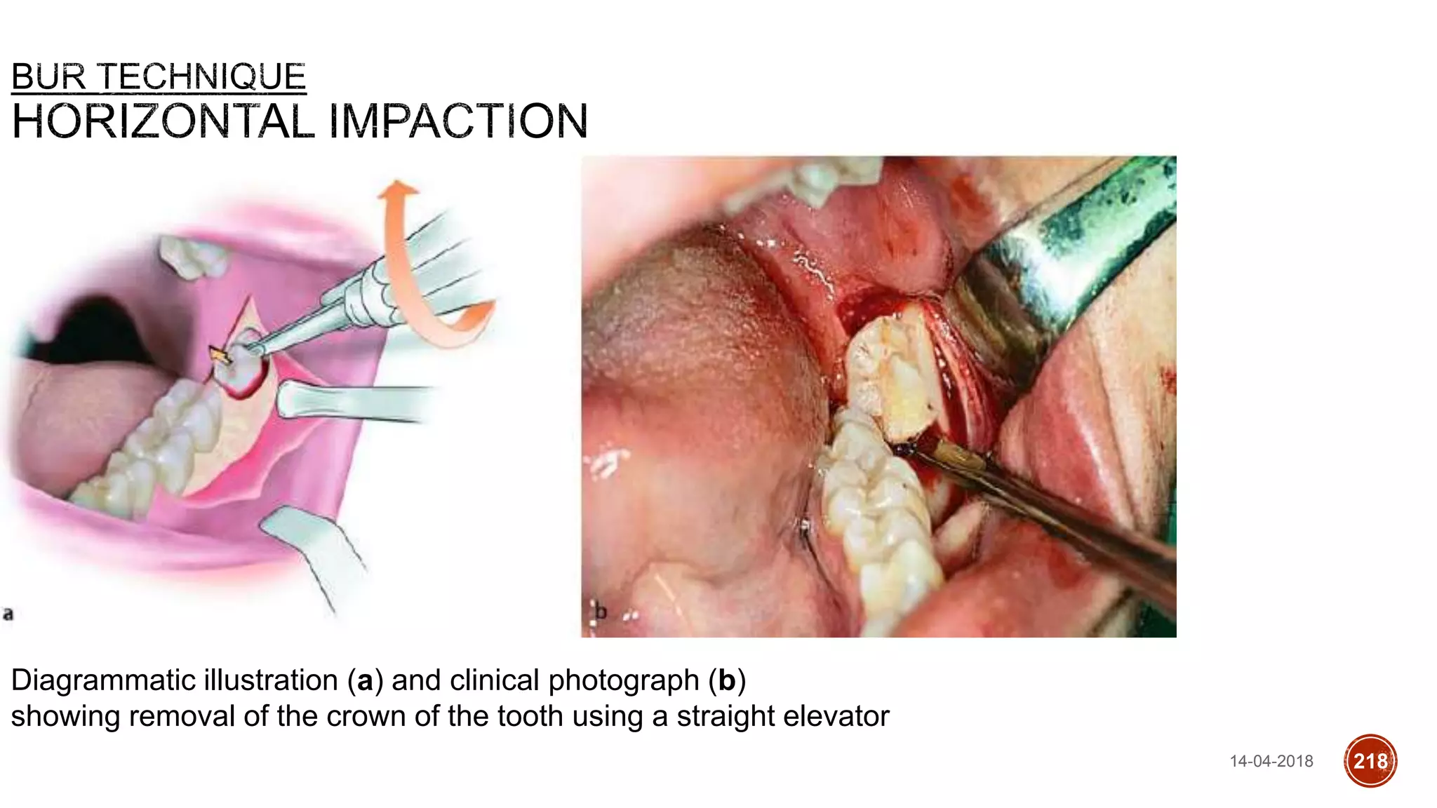 Diagrammatic illustration (a) and clinical photograph (b)
showing removal of the crown of the tooth using a straight elevator
14-04-2018 218
 