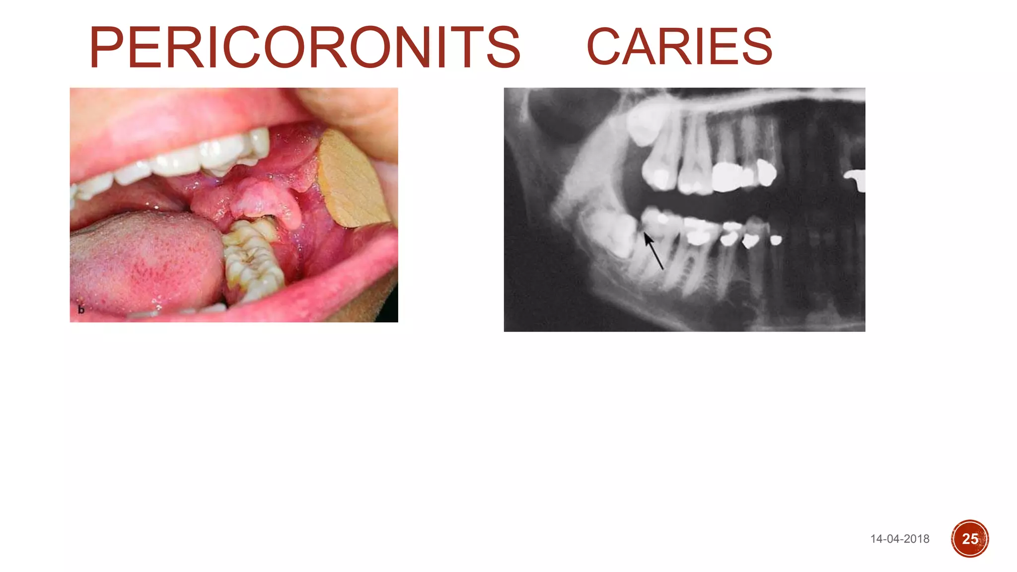 PERICORONITS CARIES
14-04-2018 25
 