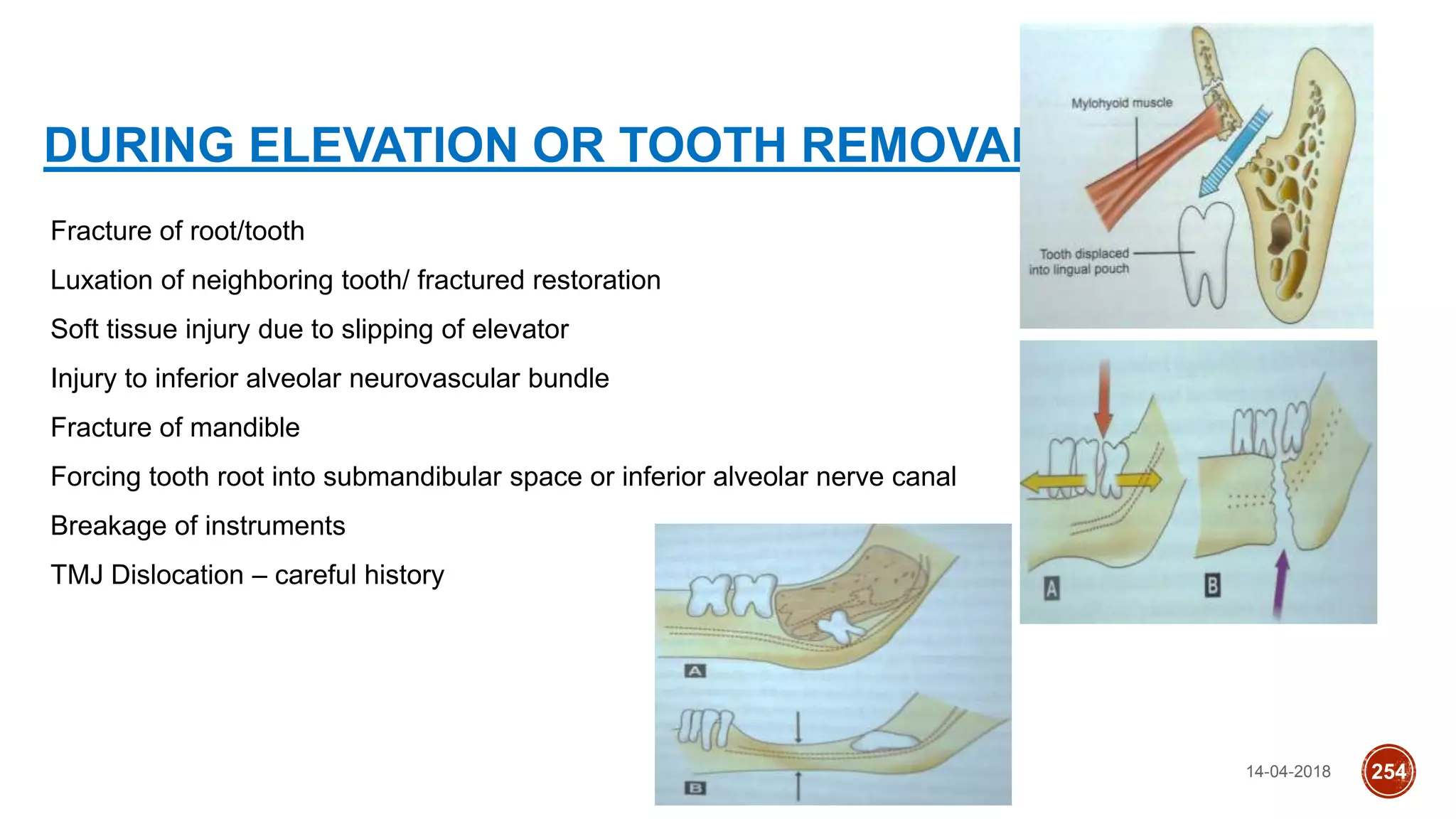 14-04-2018 254
• Fracture of root/tooth
• Luxation of neighboring tooth/ fractured restoration
• Soft tissue injury due to slipping of elevator
• Injury to inferior alveolar neurovascular bundle
• Fracture of mandible
• Forcing tooth root into submandibular space or inferior alveolar nerve canal
• Breakage of instruments
• TMJ Dislocation – careful history
DURING ELEVATION OR TOOTH REMOVAL
 