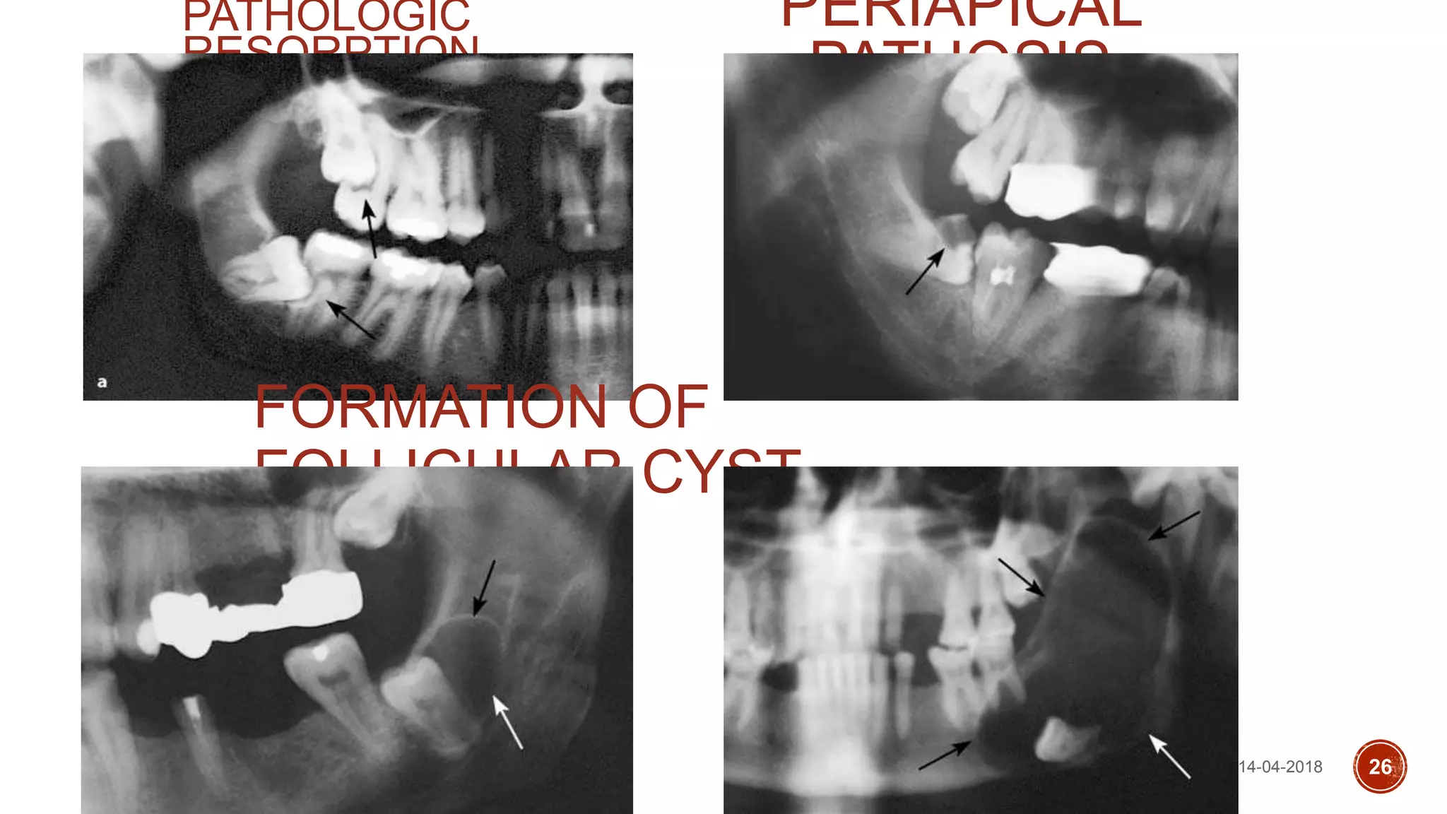 PERIAPICAL
PATHOSIS
PATHOLOGIC
RESORPTION
FORMATION OF
FOLLICULAR CYST
14-04-2018 26
 