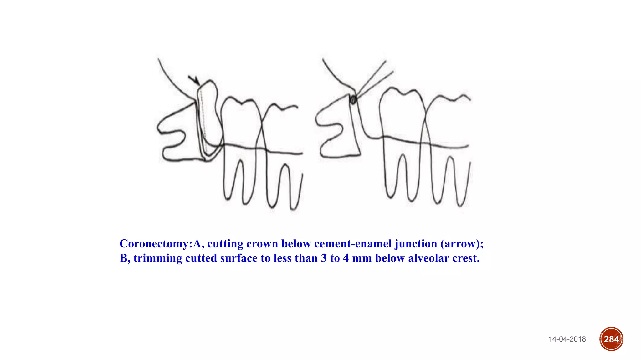 14-04-2018 284
Coronectomy:A, cutting crown below cement-enamel junction (arrow);
B, trimming cutted surface to less than 3 to 4 mm below alveolar crest.
 