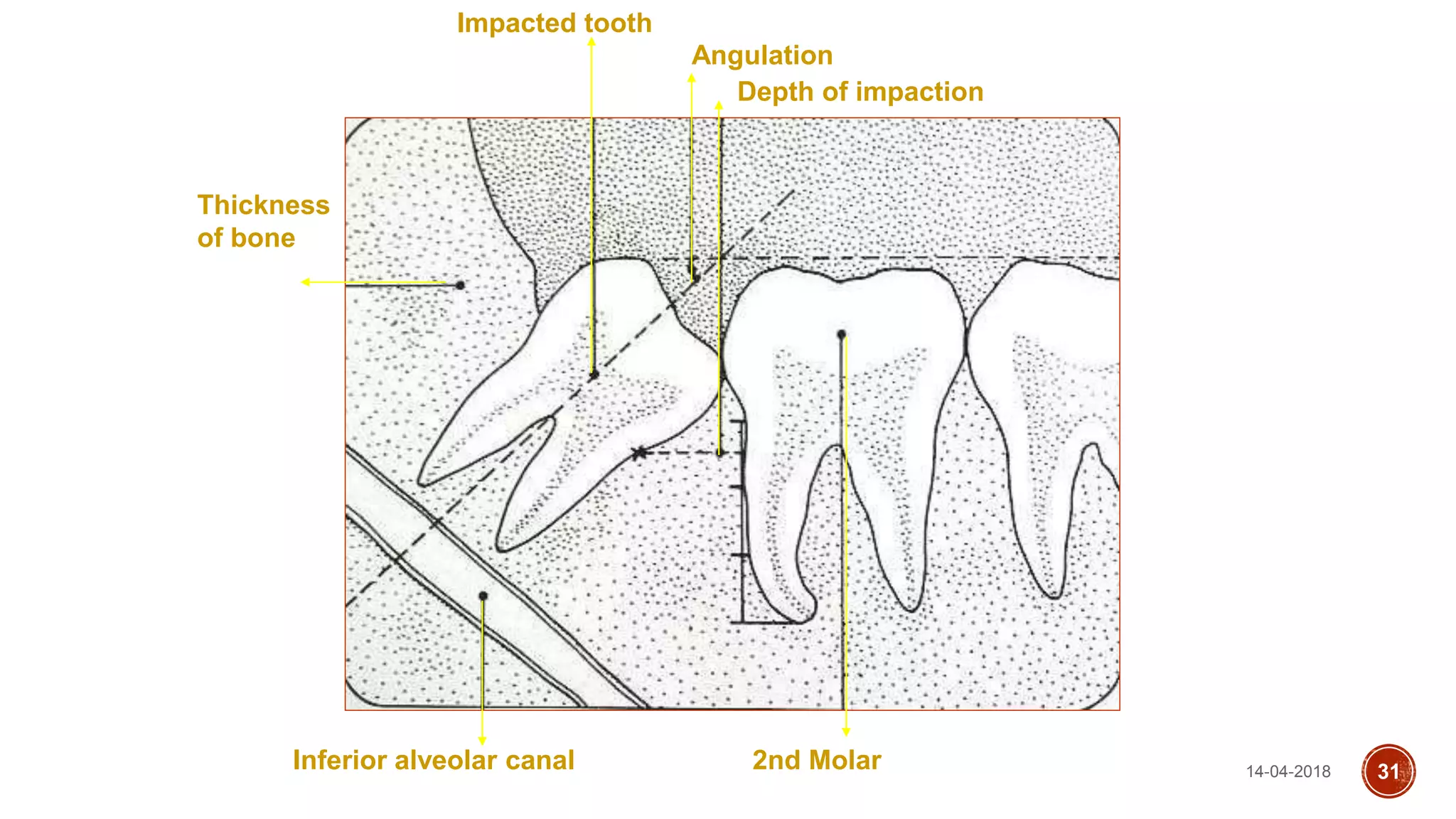 Angulation
Impacted tooth
2nd MolarInferior alveolar canal
Thickness
of bone
Depth of impaction
14-04-2018 31
 