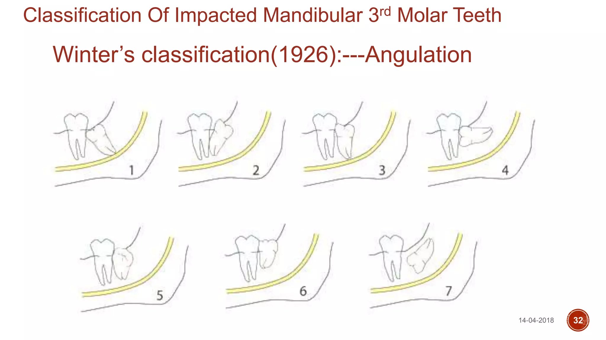 Classification Of Impacted Mandibular 3rd Molar Teeth
Winter’s classification(1926):---Angulation
14-04-2018 32
 