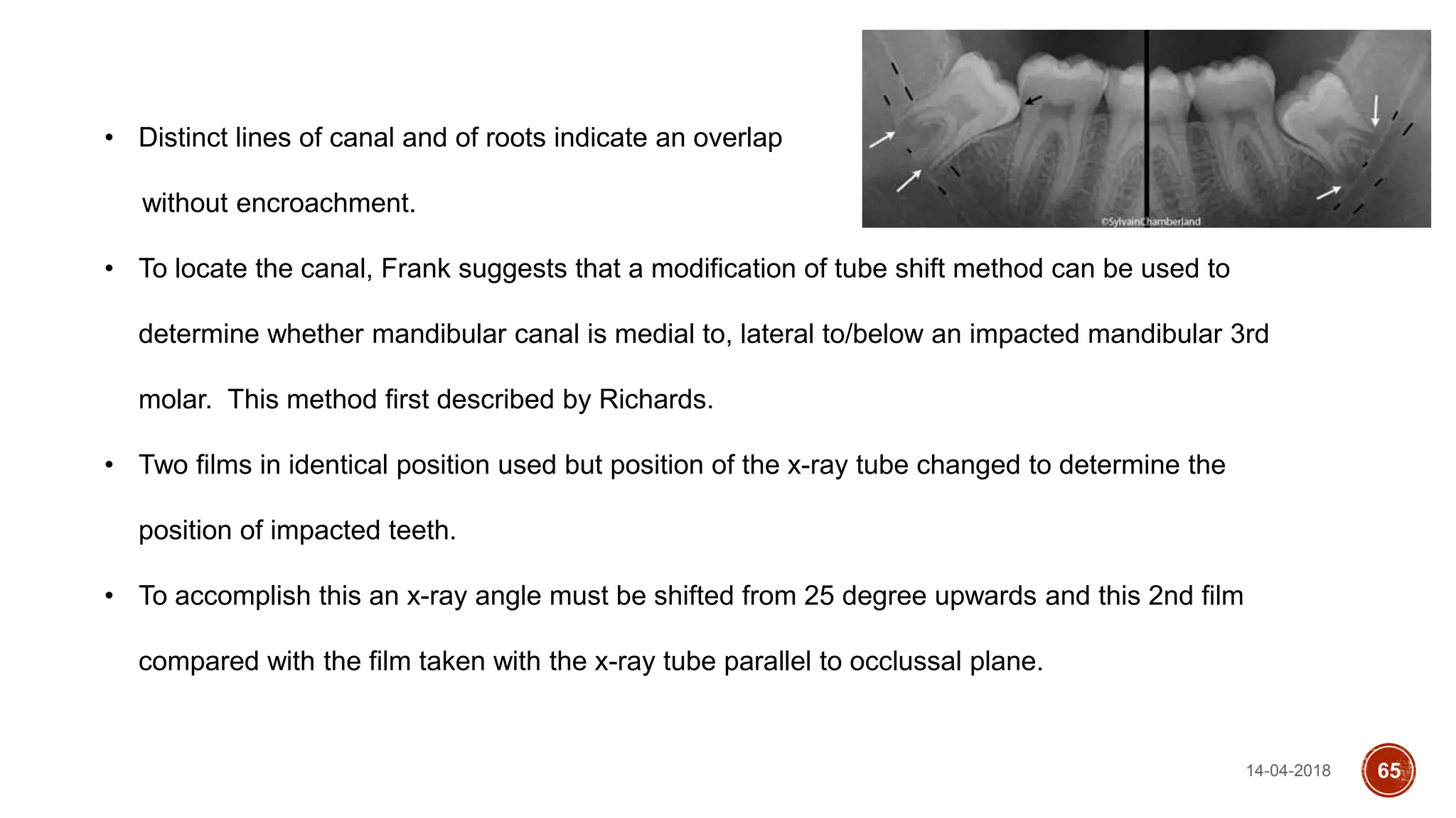 14-04-2018 65
• Distinct lines of canal and of roots indicate an overlap
without encroachment.
• To locate the canal, Frank suggests that a modification of tube shift method can be used to
determine whether mandibular canal is medial to, lateral to/below an impacted mandibular 3rd
molar. This method first described by Richards.
• Two films in identical position used but position of the x-ray tube changed to determine the
position of impacted teeth.
• To accomplish this an x-ray angle must be shifted from 25 degree upwards and this 2nd film
compared with the film taken with the x-ray tube parallel to occlussal plane.
 