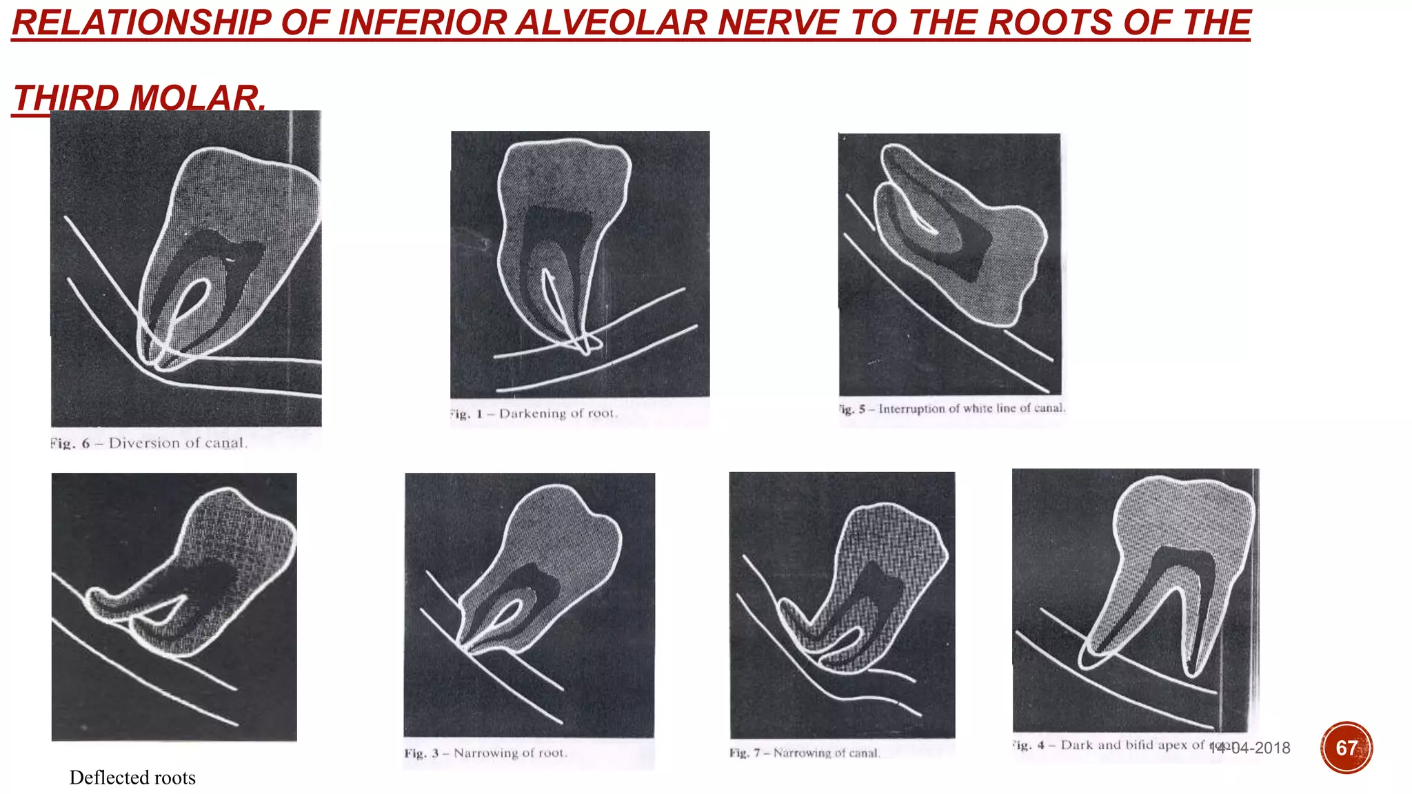RELATIONSHIP OF INFERIOR ALVEOLAR NERVE TO THE ROOTS OF THE
THIRD MOLAR.
Deflected roots
14-04-2018 67
 