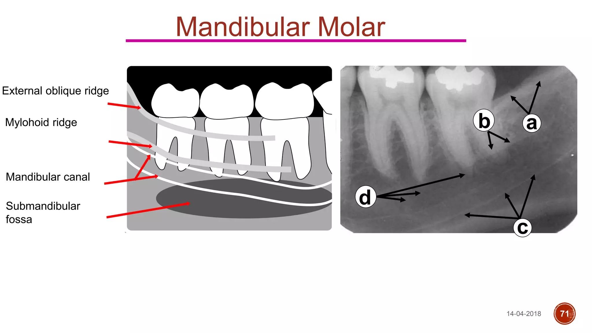 Mandibular Molar
External oblique ridge
Mylohoid ridge
Mandibular canal
Submandibular
fossa
ab
c
dd
14-04-2018 71
 