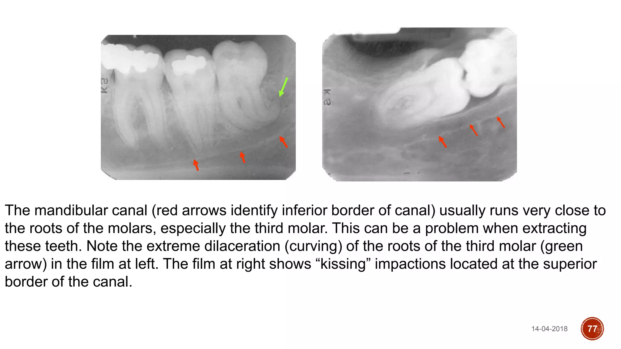 The mandibular canal (red arrows identify inferior border of canal) usually runs very close to
the roots of the molars, especially the third molar. This can be a problem when extracting
these teeth. Note the extreme dilaceration (curving) of the roots of the third molar (green
arrow) in the film at left. The film at right shows “kissing” impactions located at the superior
border of the canal.
14-04-2018 77
 