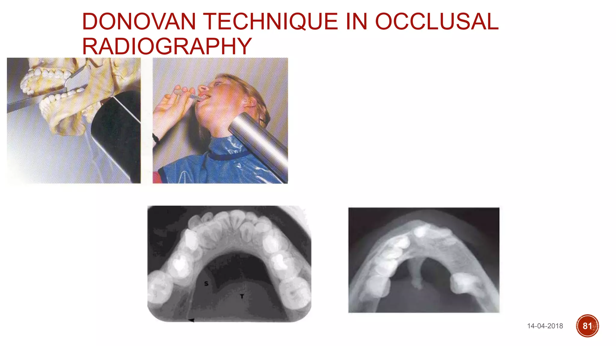 DONOVAN TECHNIQUE IN OCCLUSAL
RADIOGRAPHY
14-04-2018 81
 