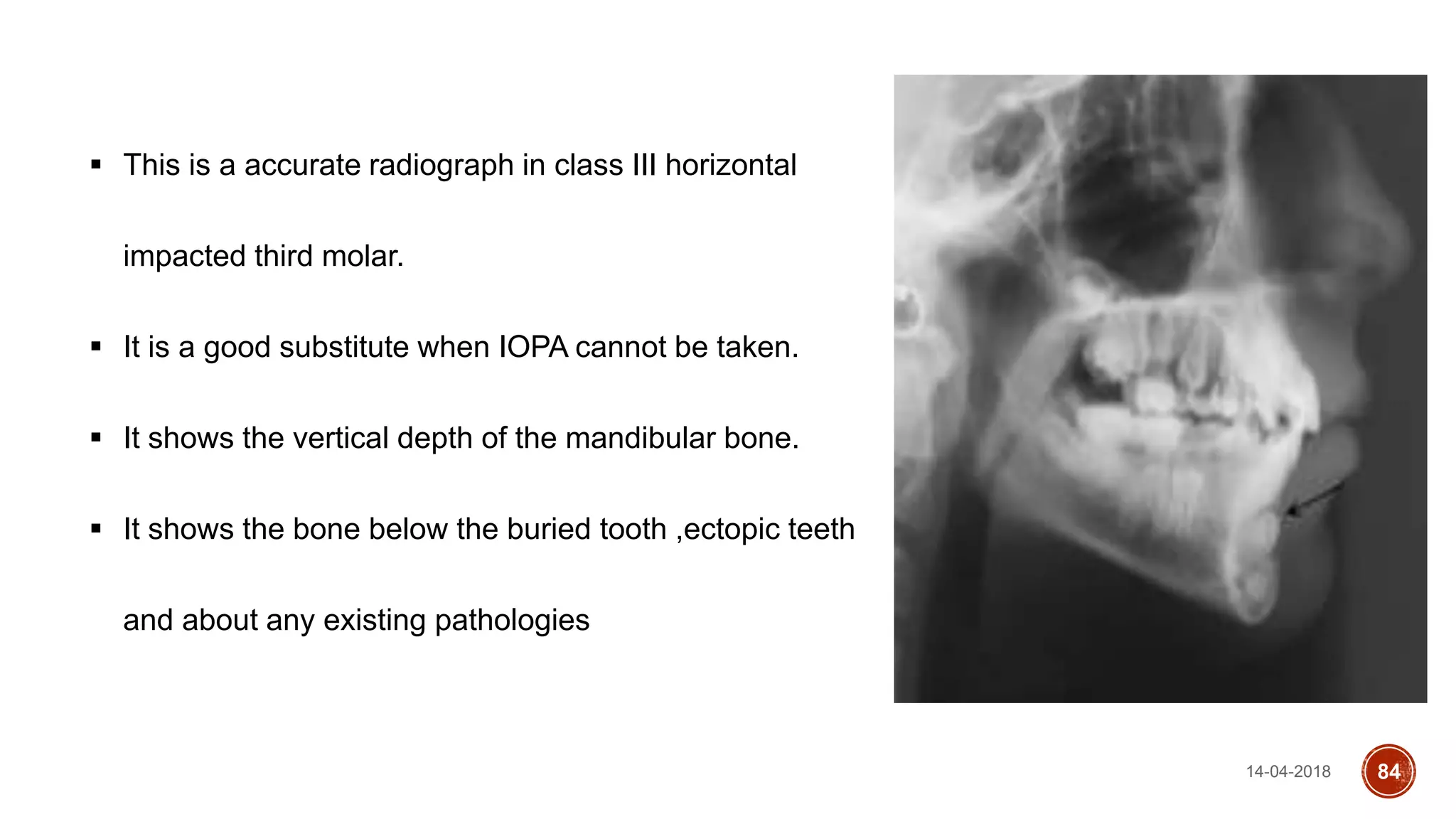 14-04-2018 84
 This is a accurate radiograph in class III horizontal
impacted third molar.
 It is a good substitute when IOPA cannot be taken.
 It shows the vertical depth of the mandibular bone.
 It shows the bone below the buried tooth ,ectopic teeth
and about any existing pathologies
 