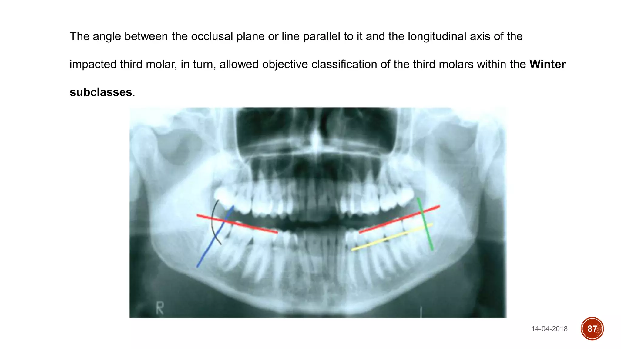 14-04-2018 87
The angle between the occlusal plane or line parallel to it and the longitudinal axis of the
impacted third molar, in turn, allowed objective classification of the third molars within the Winter
subclasses.
 