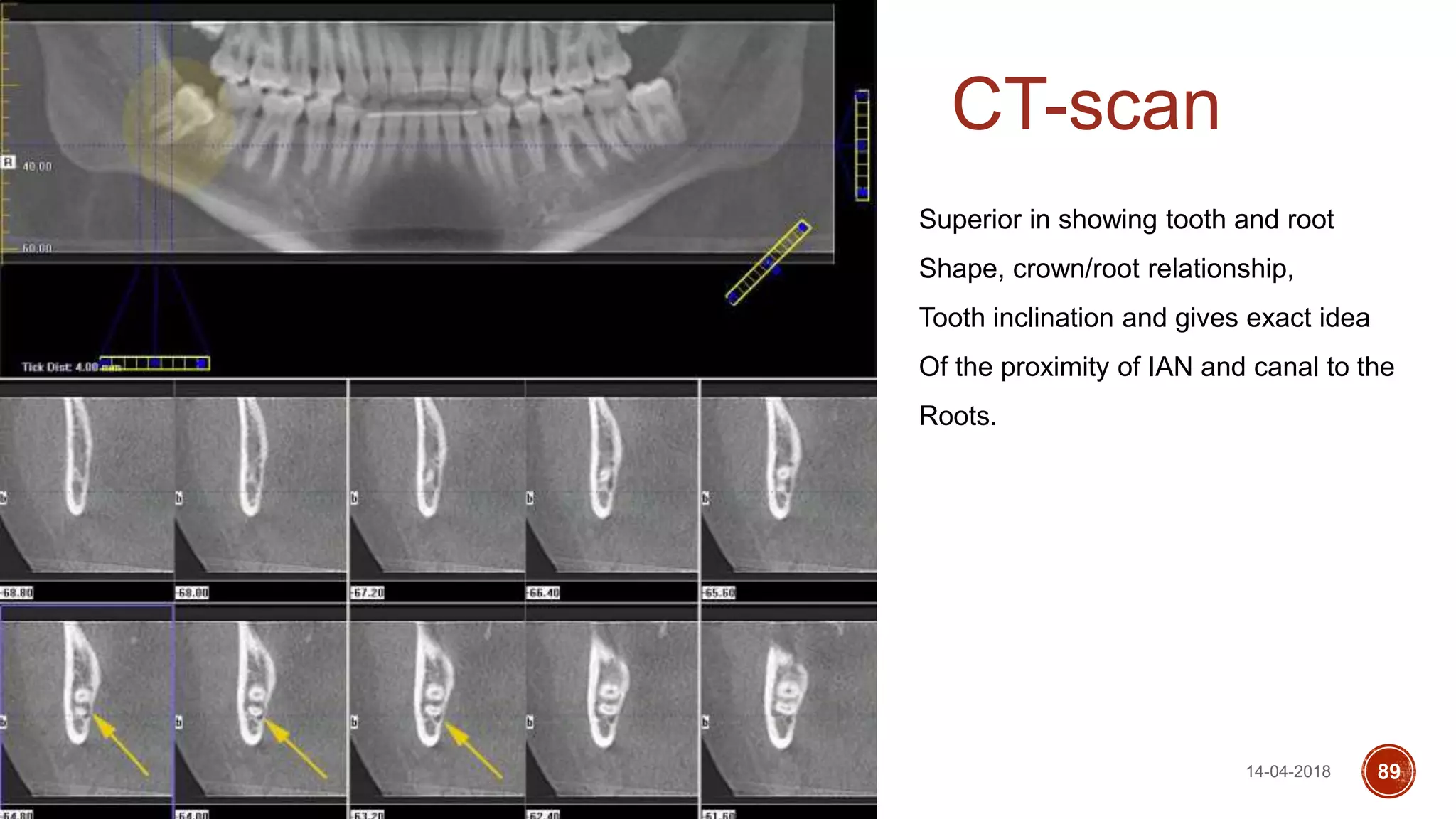 CT-scan
14-04-2018 89
Superior in showing tooth and root
Shape, crown/root relationship,
Tooth inclination and gives exact idea
Of the proximity of IAN and canal to the
Roots.
 