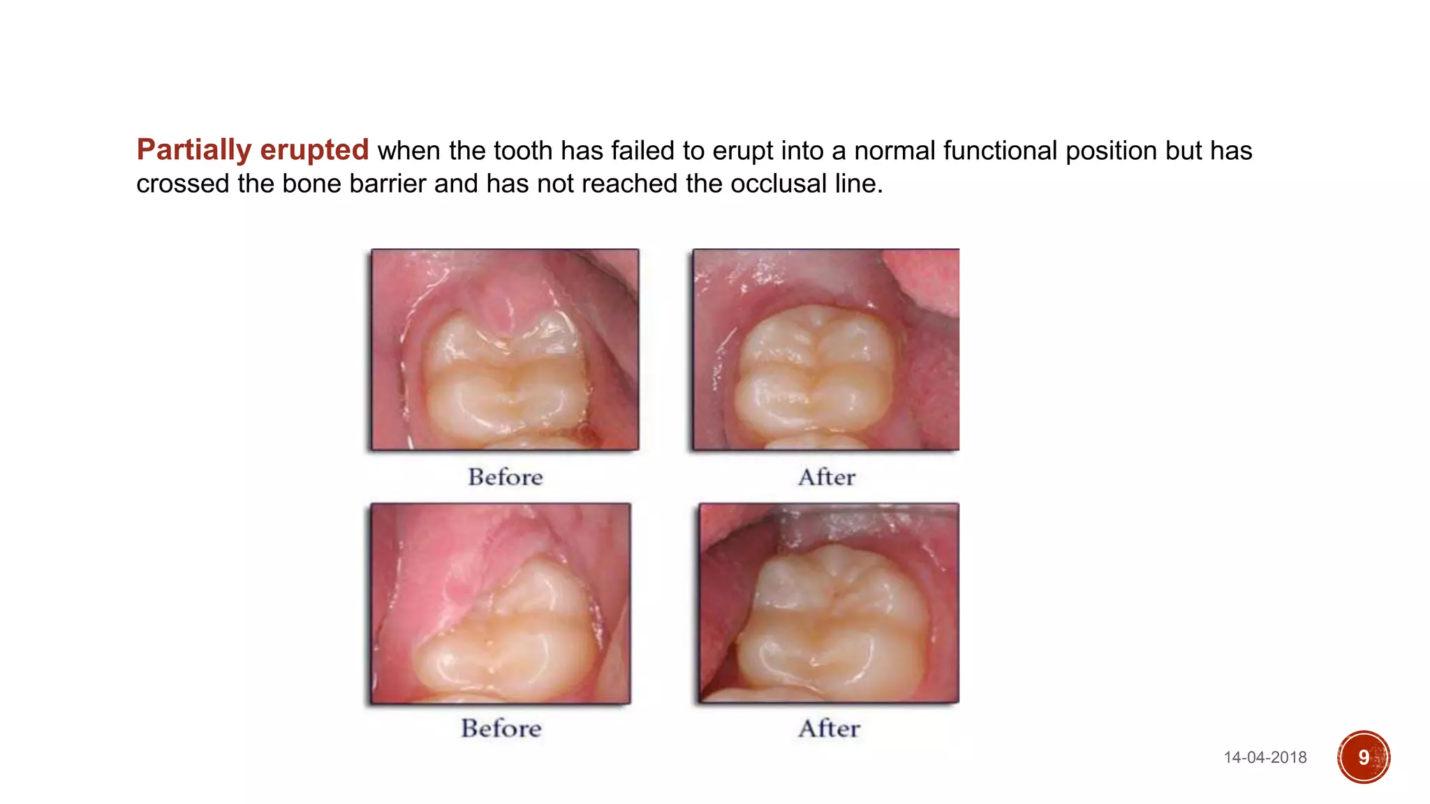 14-04-2018 9
Partially erupted when the tooth has failed to erupt into a normal functional position but has
crossed the bone barrier and has not reached the occlusal line.
 