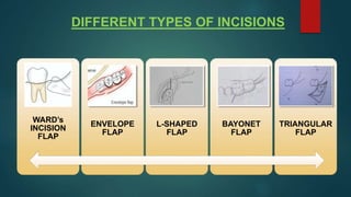 Impaction.pptx