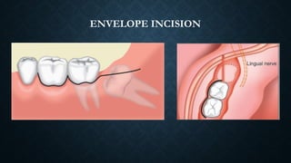 Impaction- definition, theories, indications, surgical techniques | PPTX