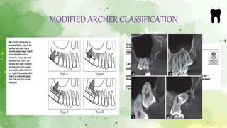Impaction maxillary teeth part 1 | PPTX