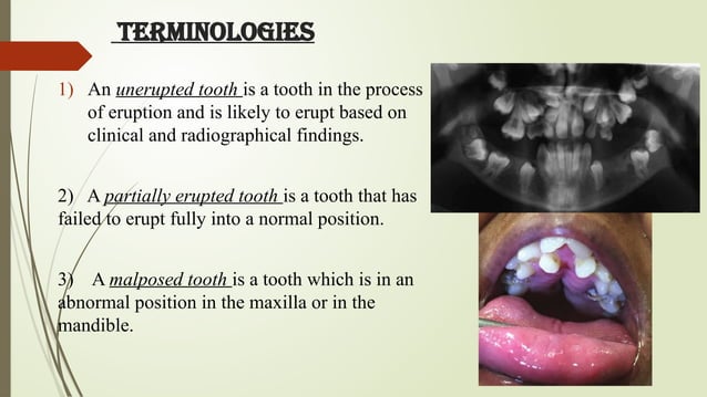 IMPACTION - Oral Surgery by Dr. Kenil Tarpara.pptx
